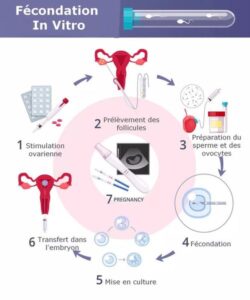 LA FÉCONDATION IN VITRO