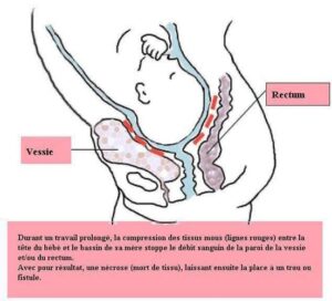 Les fistules obstétricales