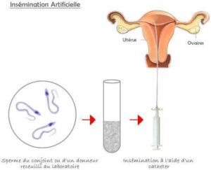 Insémination articifielle